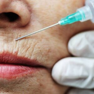 Smokers' Lines with Toxin&nbsp;Online